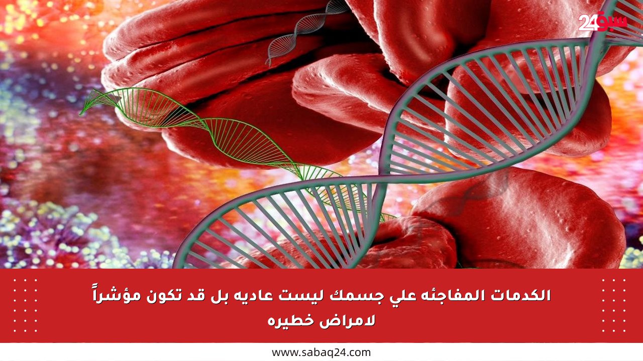 الكدمات المفاجئة على جسمك ليست عادية بل قد تكون مؤشراً لأمراض خطيرة